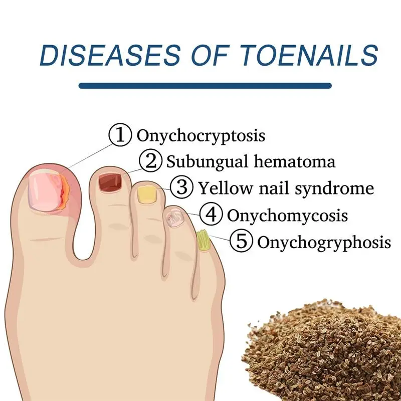 Parche para tratamiento de paroniquia, herramientas de pedicura, eliminación de hongos, pegatinas de corrección encarnadas, cuidado de la salud, 32 piezas