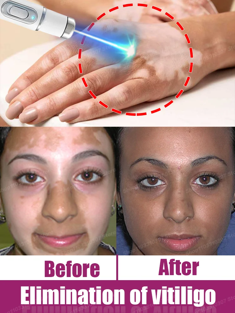 

Vitiligo Quickly Improves White SPots