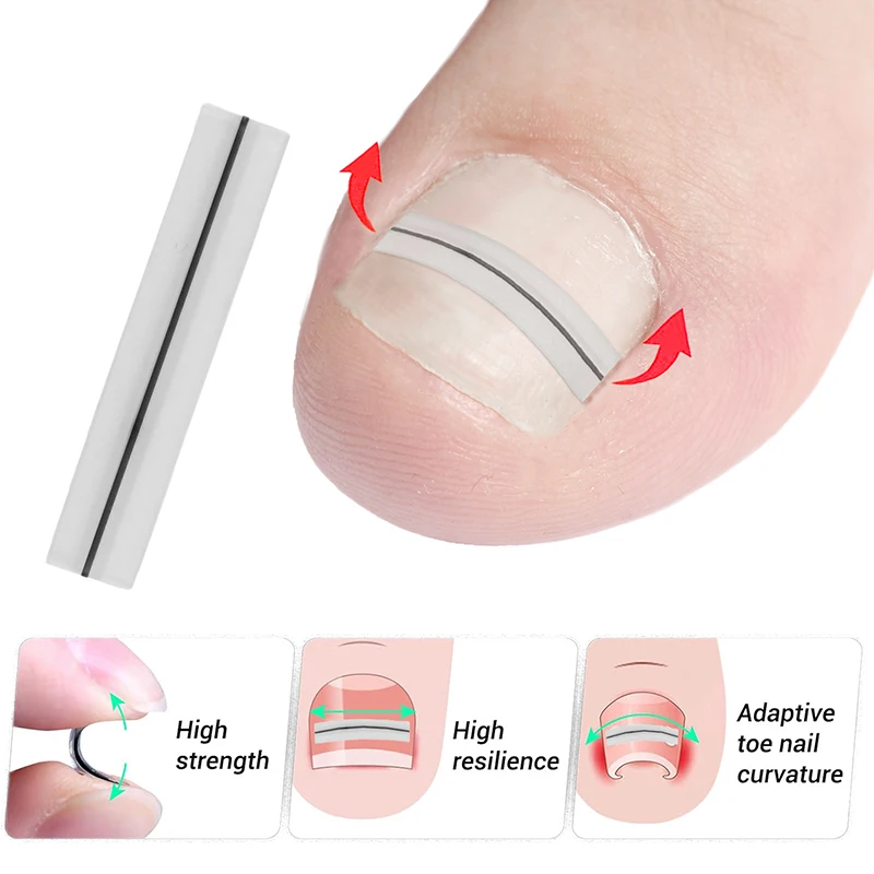 Ingegroeide teennagel Correctie Tool Rechttrekken Clip Brace Ingegroeide teen Nagelbehandeling Elastische patch Sticker Pedicure Tool