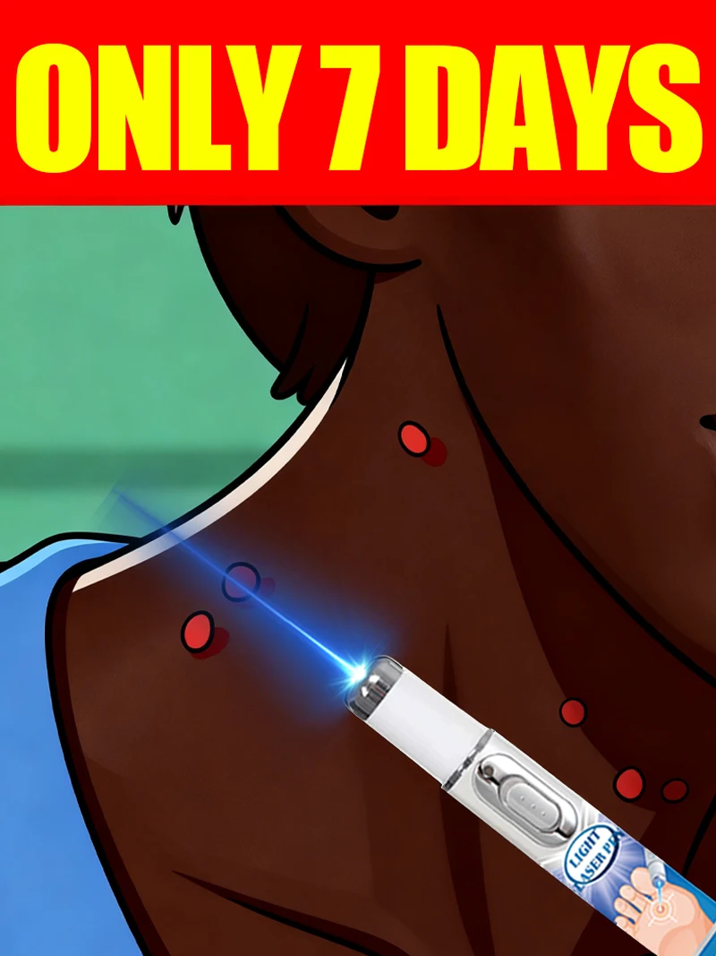 

blue light pen solve Various warts, hot sale wart care tools