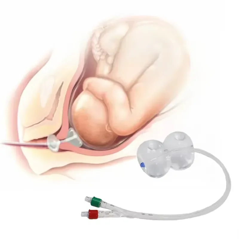 Factory Direct Silicone Capacity 80ml Length 400mm Disposable Cervical Ripening Balloon Dilation Catheter