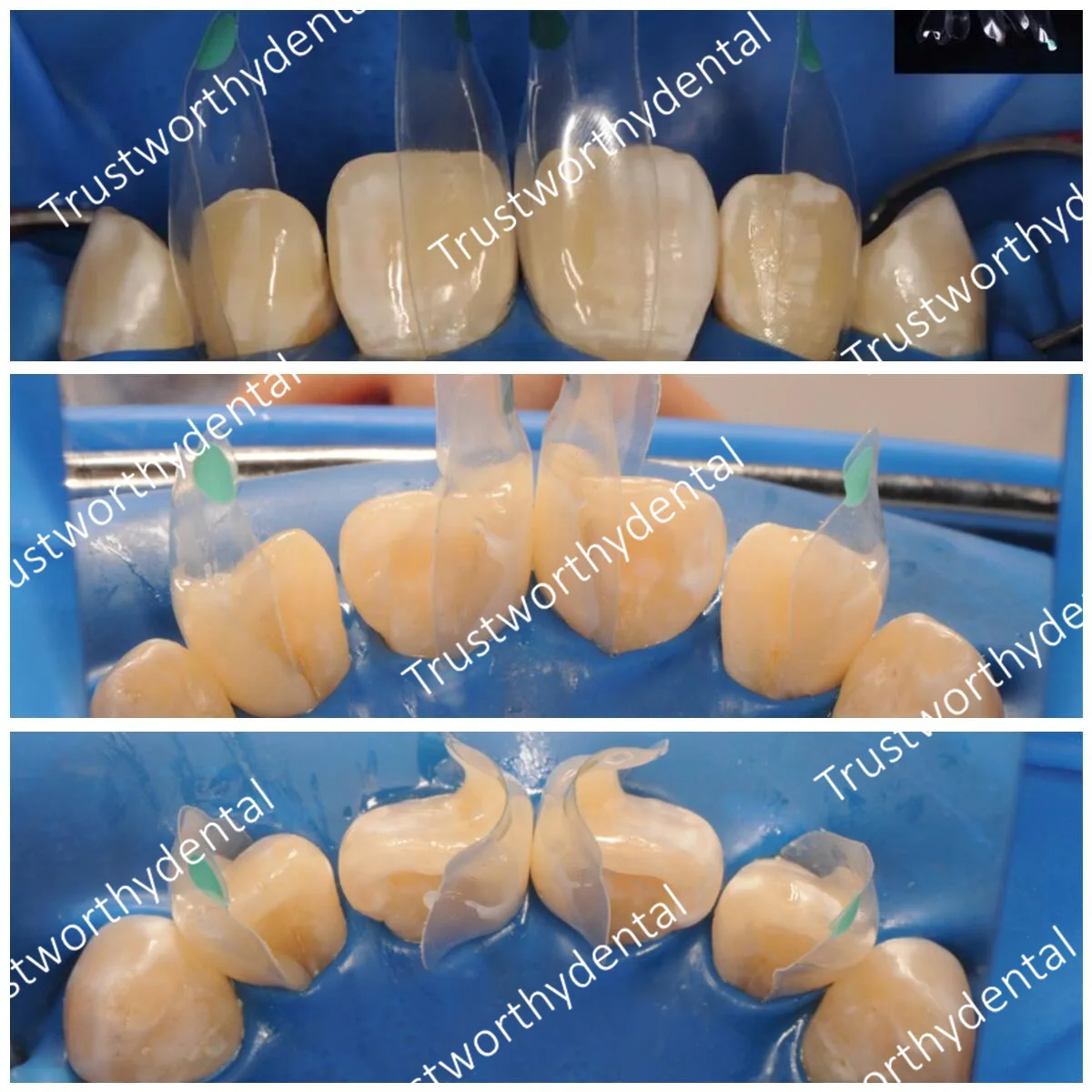 5Pieces Dental Clear Matrix Anterior/Posterior Teeth Transparent Matrix Fit Bioclear BT 6Size