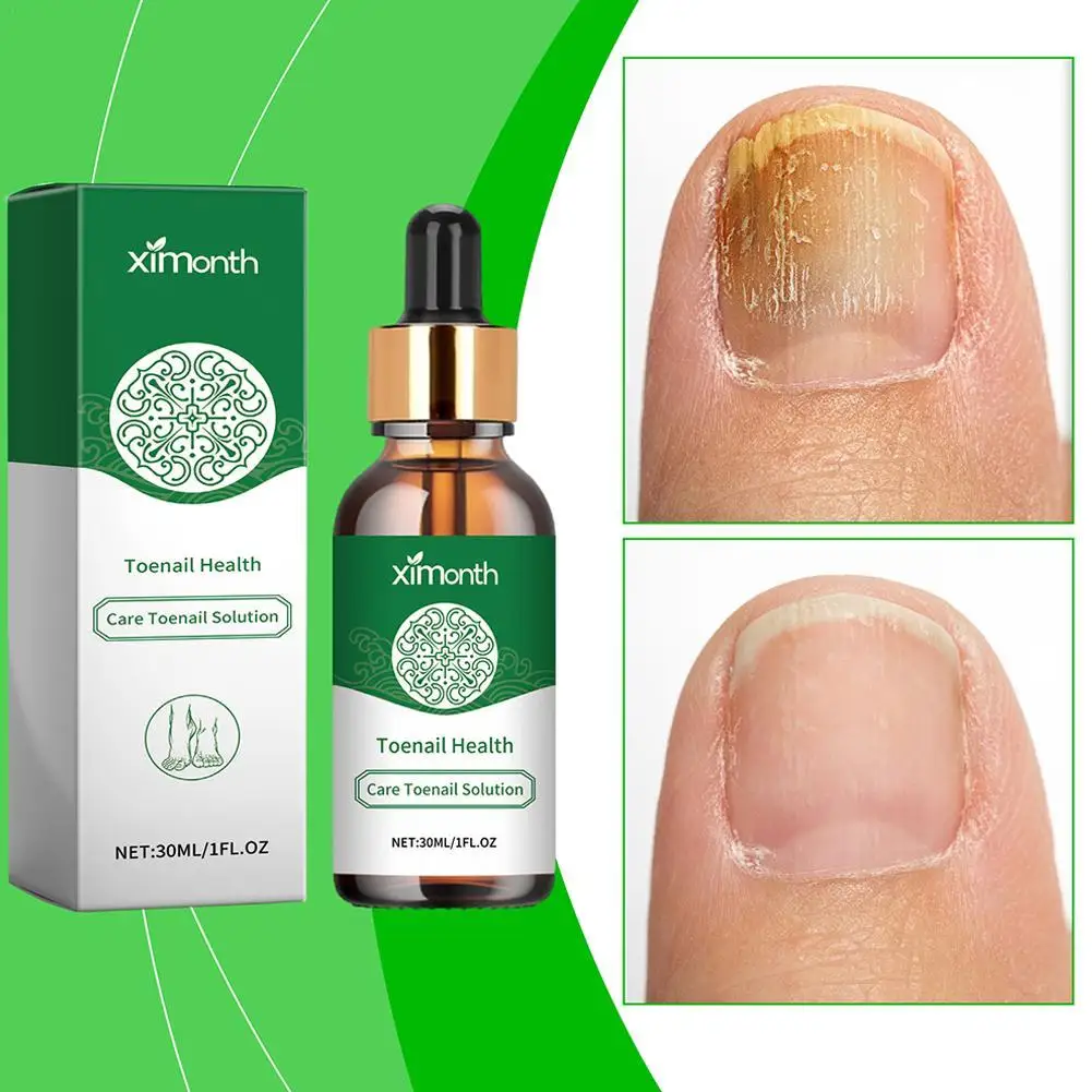 

Ximonth Nail Fungal Treatment Essence Oil Foot Toe Nail Fungus Removal Serum Onychomycosis Anti Infection Gel Beauty Health Care