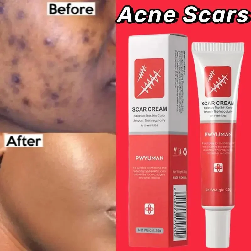 Powerful Scar Removal Cream Heal Old Deep Keloid Scar Treat Stretch Marks Burn Surgical Acne Spot Repair Whitening Skin 1/3/5pcs