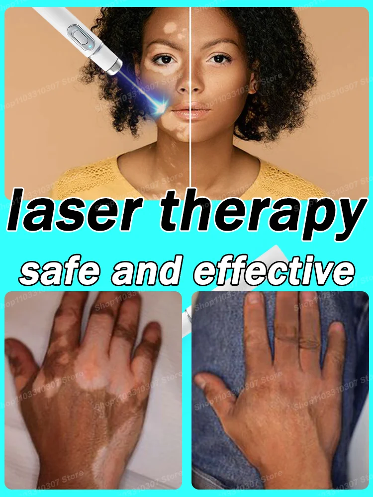 

Laser Therapy Vitilig0