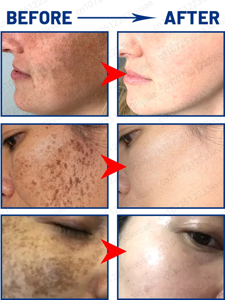 Esencia para eliminar pecas, manchas oscuras, cloasma, pecas, eliminación de manchas pigmentadas de la edad.