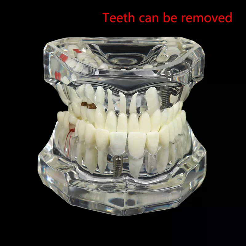 

1PCS Dentist Disease Teeth Model With Restoration Bridge Tooth For Medical Science Dental Disease Teaching Study Dental Implant