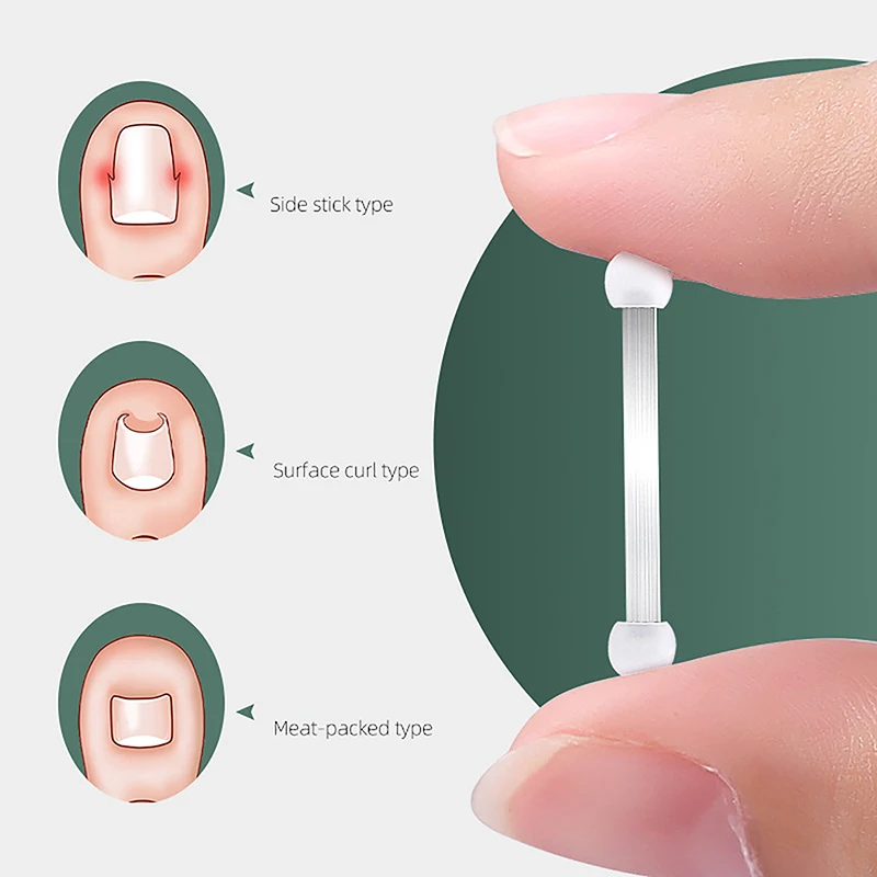 💖 CALDO ❗ Strumenti per la correzione dell'unghia del piede incarnita Pedicure Recupera nel trattamento delle unghie dei piedi incorporati Strumento professionale per la cura del piede dell'unghia del piede incarnita