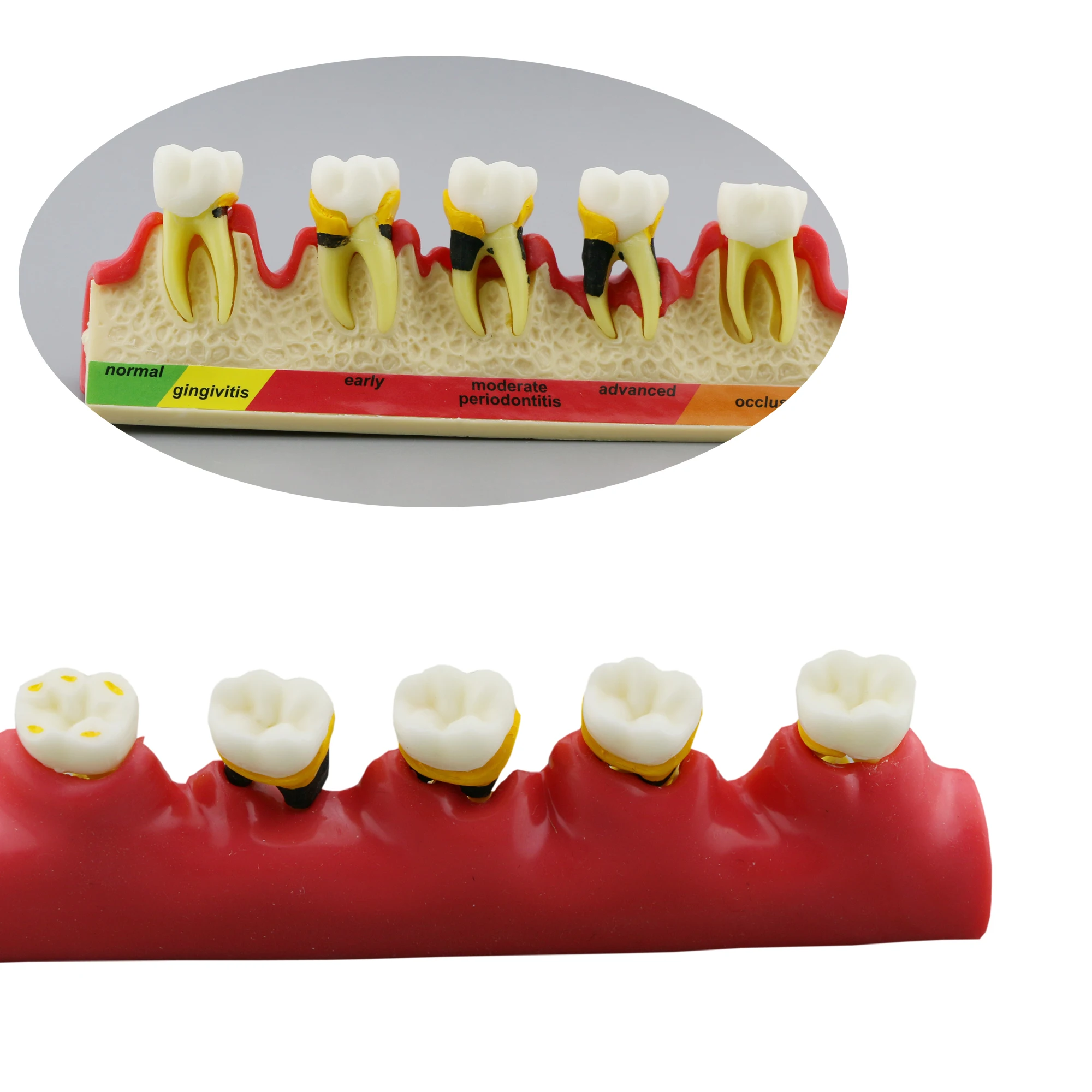 

Dental Periodontal Disease Model Typodont Teeth Model Periodontics (PER) 4010