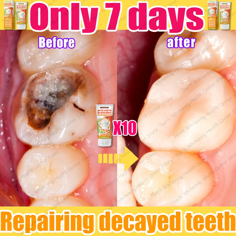 Cleaning decayed teeth and restoring the oral cavity