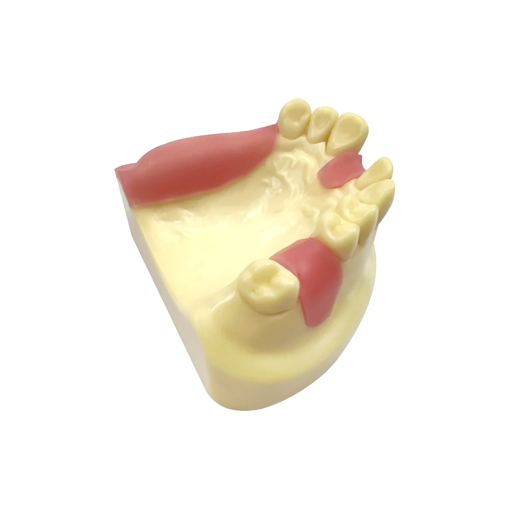 

Dental Model Mandibular Jaw Implant Study Education Teach With Missing Tooth Dental Implant Teeth Model Dentist Studying Demo