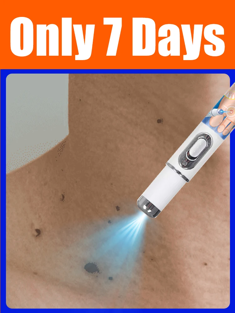 いぼに悩んでいますか？2025年最新ブルーライトケアペンで、プロレベルのいぼ除去を。 優しく、痛みがなく、私にとって安全です