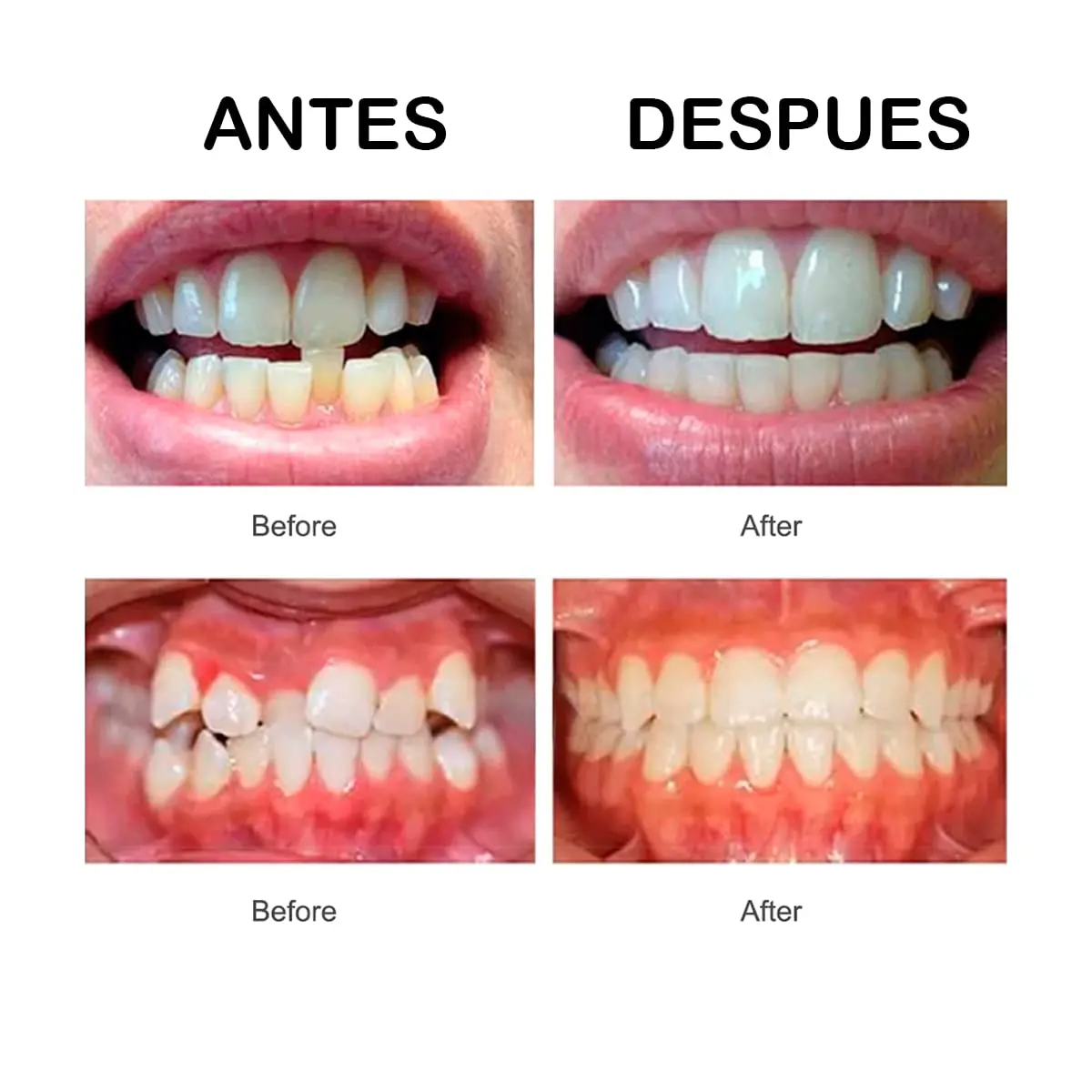 Protector de dientes para corrección de sonrisa, dispositivo de ortodoncia Dental, suave y duro, transparente, 3 etapas