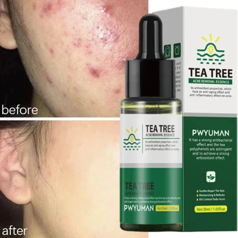 

Tea Tree Acne Removal Serum Repair Acne Serum Oil Shrink Pore Remove Blackheads Facial Cleaning Fade Acne Marks Whitening