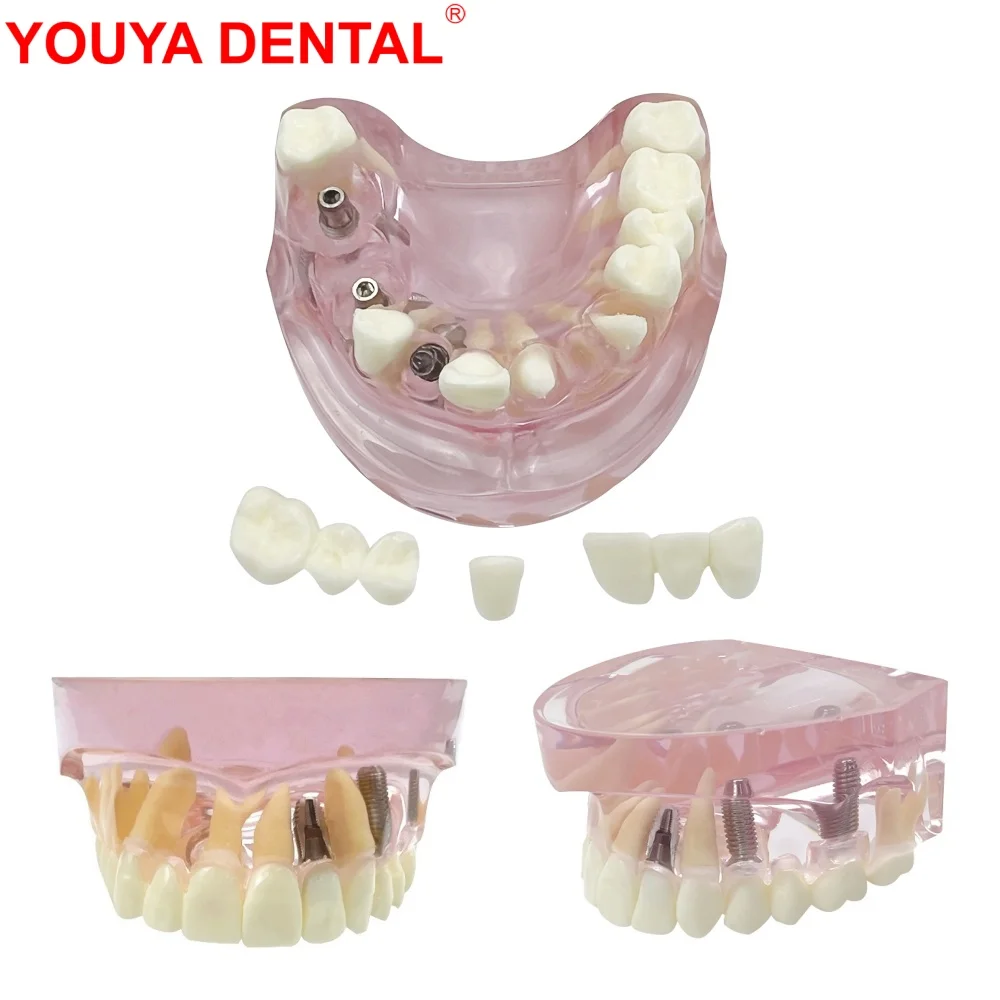 3 Implants Maxillary Teeth Implant Model Upper Jaw Restoration Dental Model With Removable Tooth For Teaching Education Studying