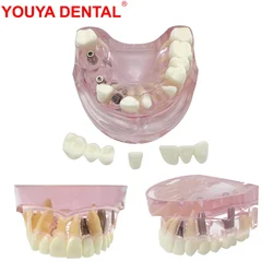 3 Implants Maxillary Teeth Implant Model Upper Jaw Restoration Dental Model With Removable Tooth For Teaching Education Studying