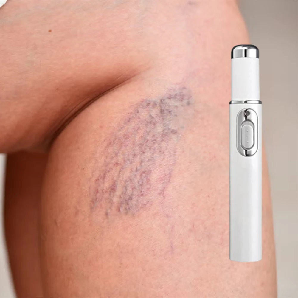 

Blood Circulation Varicose Vein Laser Device Pen - Leg Vein Therapy for Spider Veins Leg Care