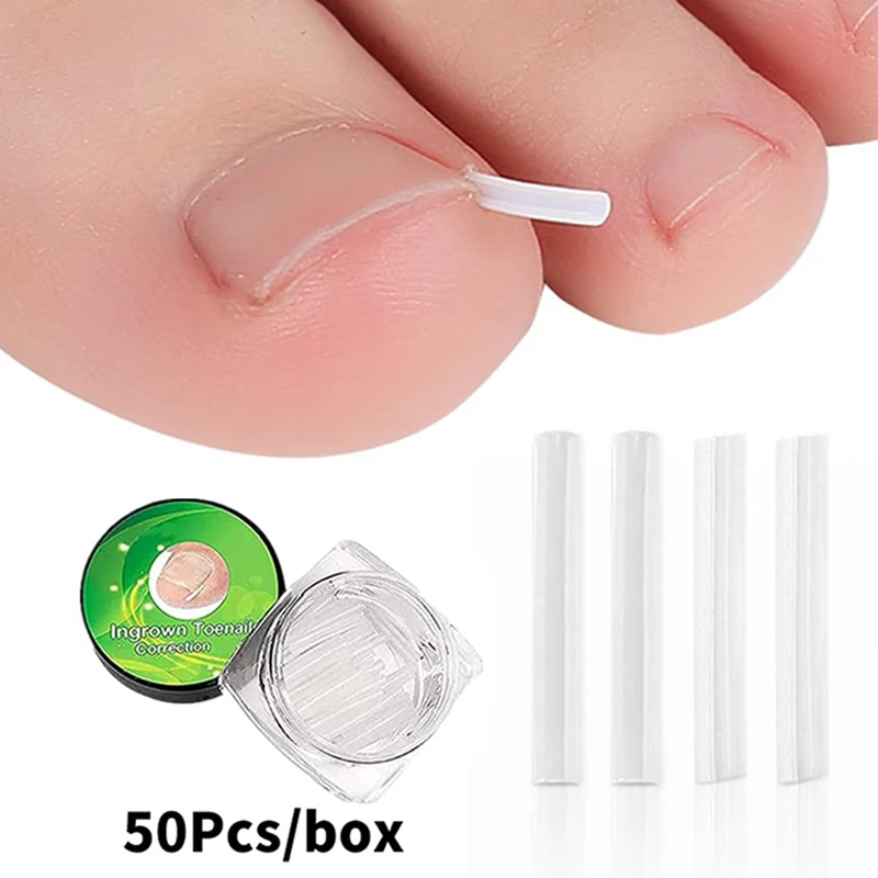 50 Stuks Ingegroeide Teennagel Correctie Tool Ingegroeide Teen Nagel Behandeling Elastische Patch Sticker Rechttrekken Clip Brace Pedicure Tool