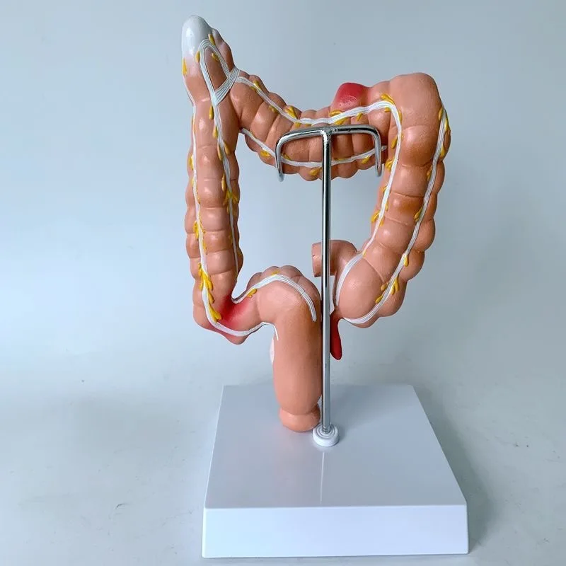 Colonic lesion model Intestinal disease human colonic lesion model