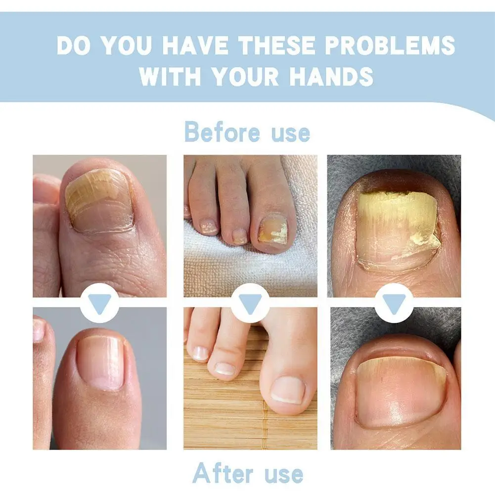 Nagelverzorging Gel Hand En Voet Onychomycosis Zachte Nagel Nagel Verheldering Nagel Verdikking Reparatie Behandeling Gel R0g2