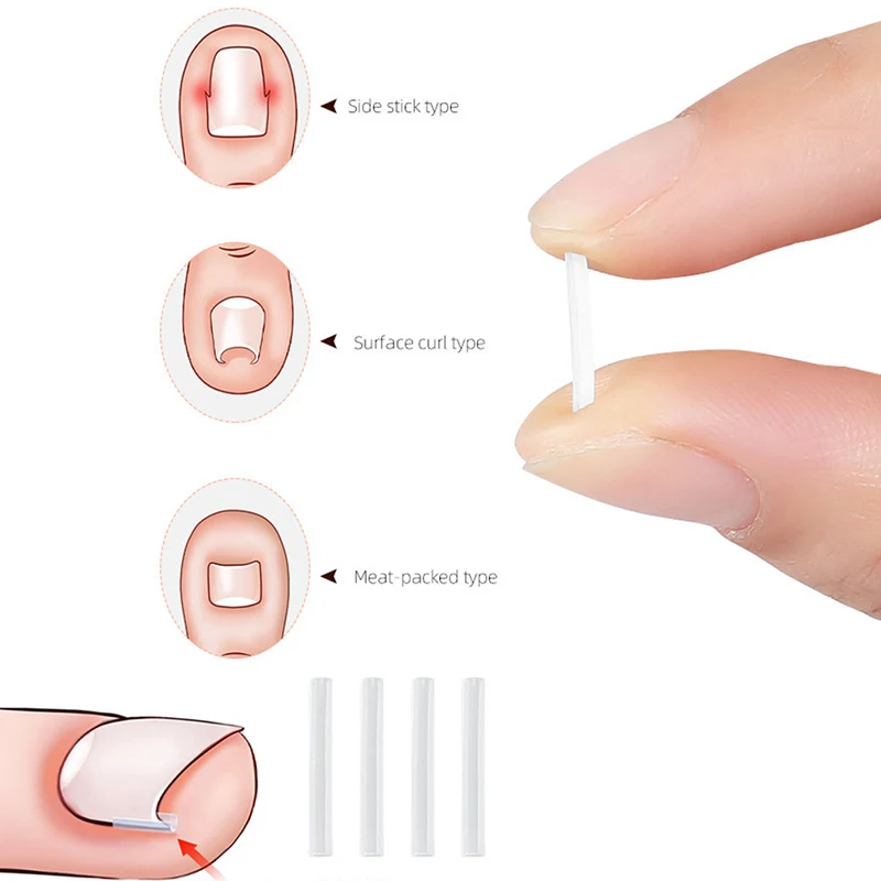 10Pcs Ingrown Toenail Correction Tool Ingrown Toe Nail Treatment Elastic Patch Sticker Straightening Clip Brace Pedicure Tool