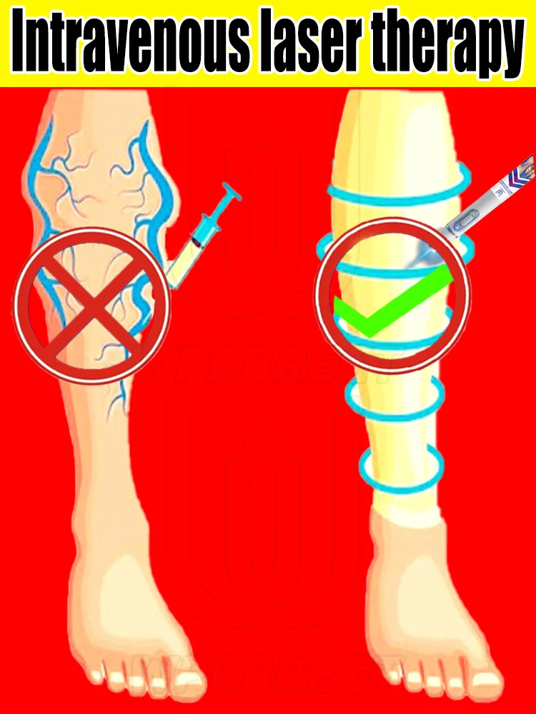 

Лазерная указка для варикозного расширения вен, паукообразных вен, опухлых вен, прыщей, геморой.