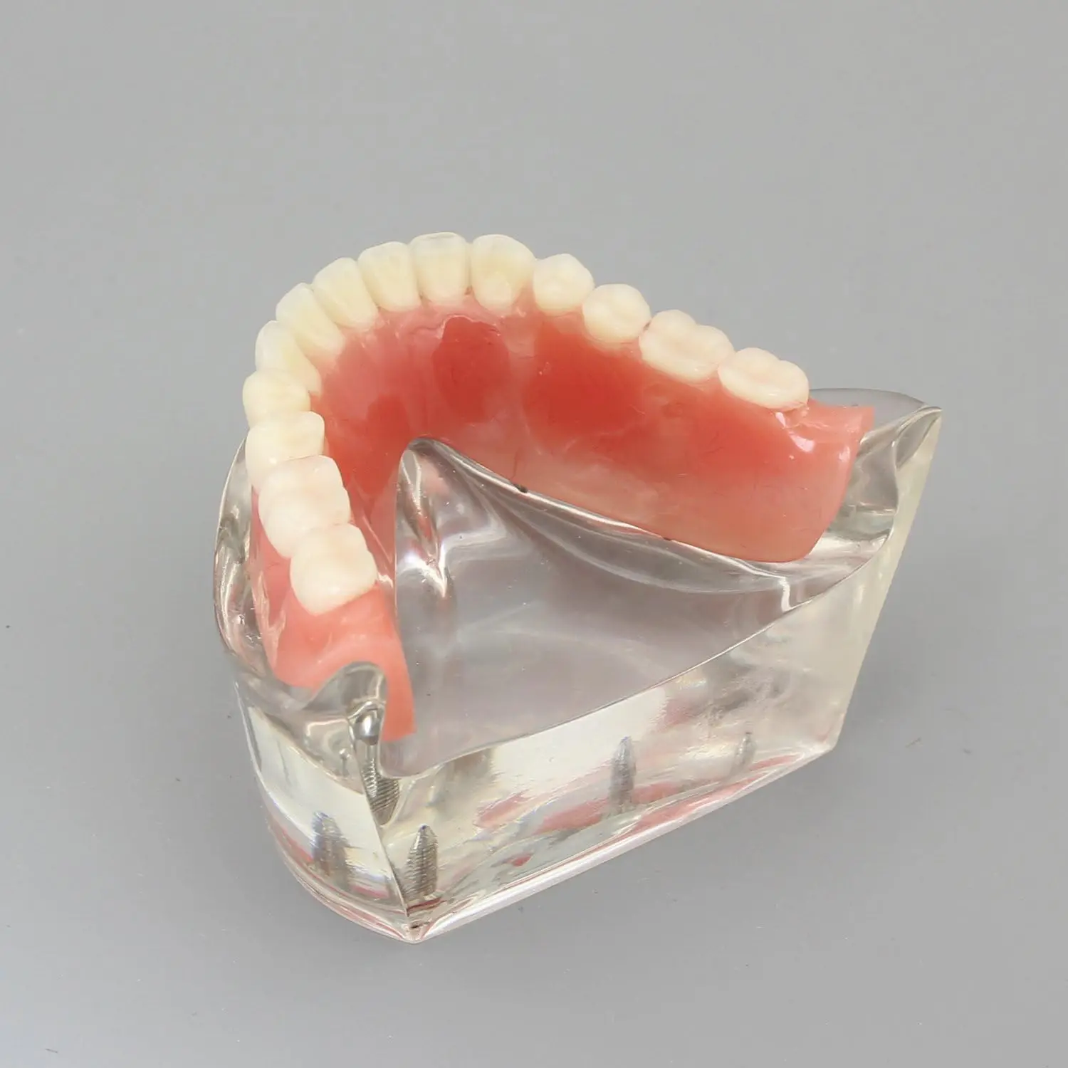 Bild 4: AG Dental-Zahnmodell für den Unterricht, Bildung, Studium, Zahnmedizin, Oberkiefer/Mandibular, Overdenture, Unterkiefer-Zahnmodell