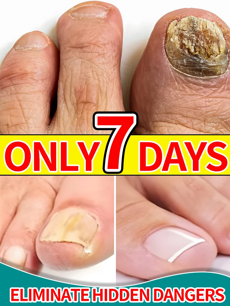 

Blue light device Applicable to Onychomycosis