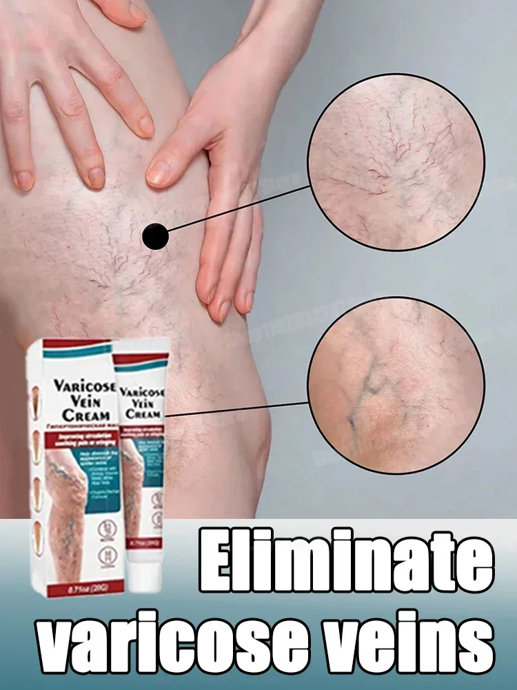 

Varicose vein relief cream for leg spasms, vasculitis, phlebitis, spider vein protrusion pain ointment 1