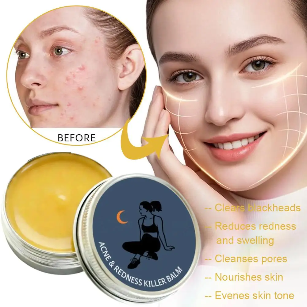 

50ml Multi-Active Acne Cream – Natural Ingredients to Clear Acne, Reduce Redness & Soothe Irritated Skin, Evens Skin Tone