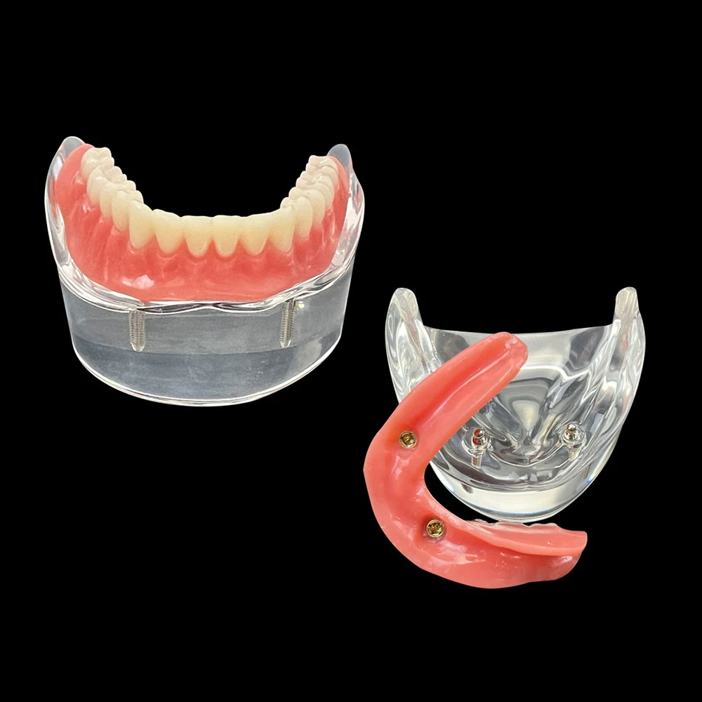 Dental Overdenture Teeth Model 2 Implants Demo Model 6002 Removable Restoration Dentist Student Learning Lower Model