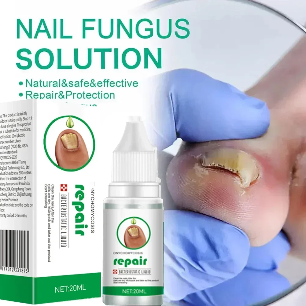 

Strong Nail Fungus Treatment Serum Essence oil Feet Nails Repair Care Essence Cream Anti Infection Toe Fungal Removal