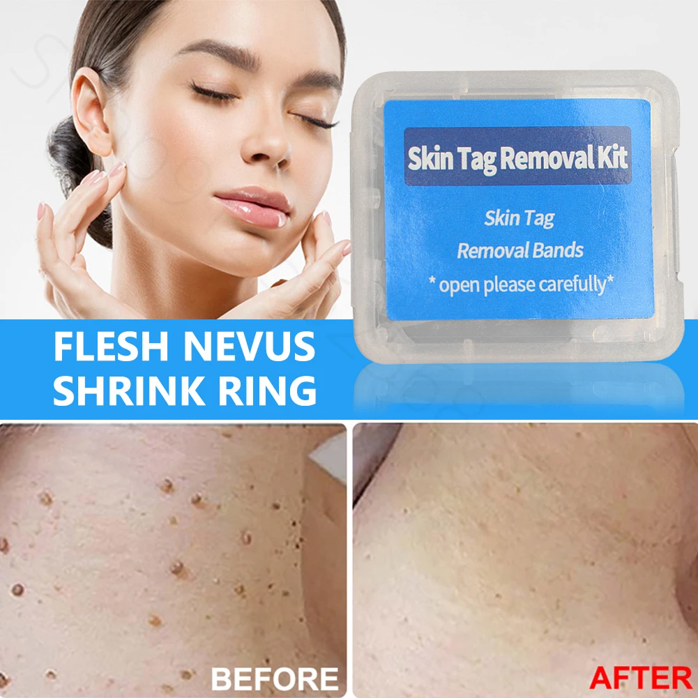 30pcs/box Flesh Nevus Removal Bands Non-Toxic Mole Removal Rubber Bands Kit Wart Treat Tool for Men Women Face Skin Care