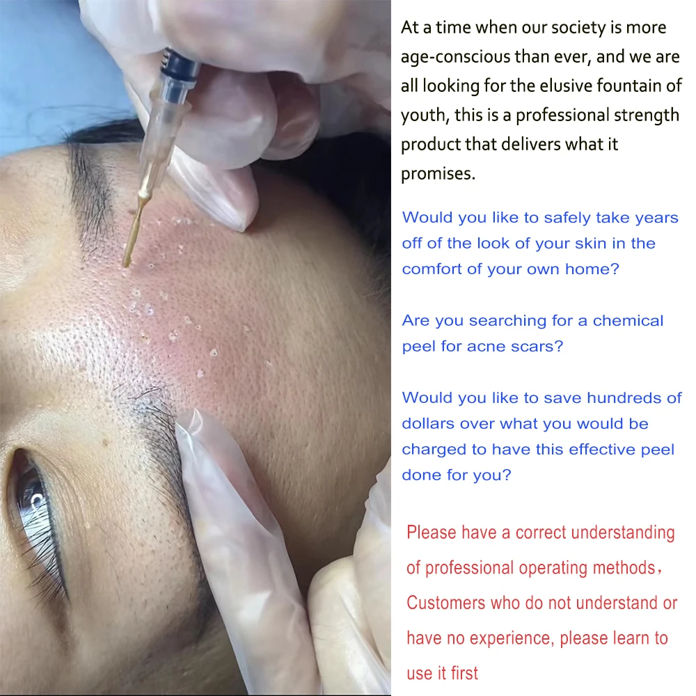 Skin Rejuvenation TCA 20 35 50 70 Peel for Sun Damage Fine Lines Wrinkles Dull Skin Uneven Skin Tone Enlarged Pores Melasma