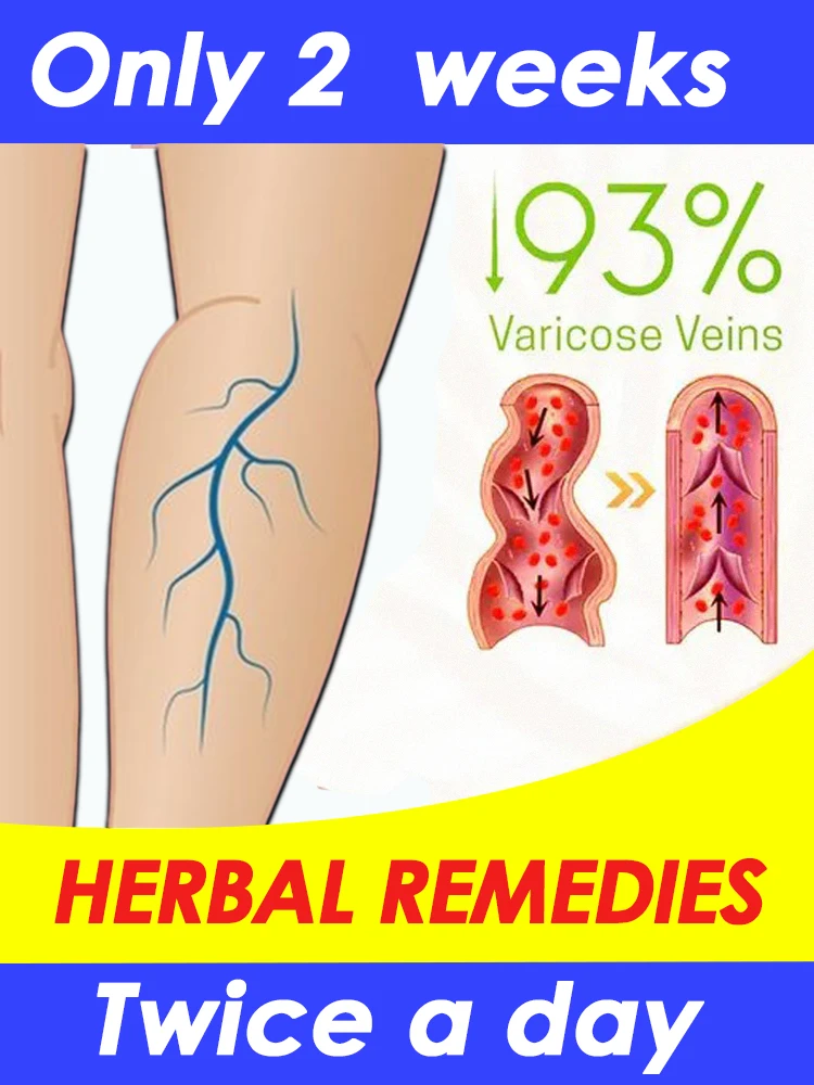 

South Moon-Third Generation Veins Cream 30g Twice a day