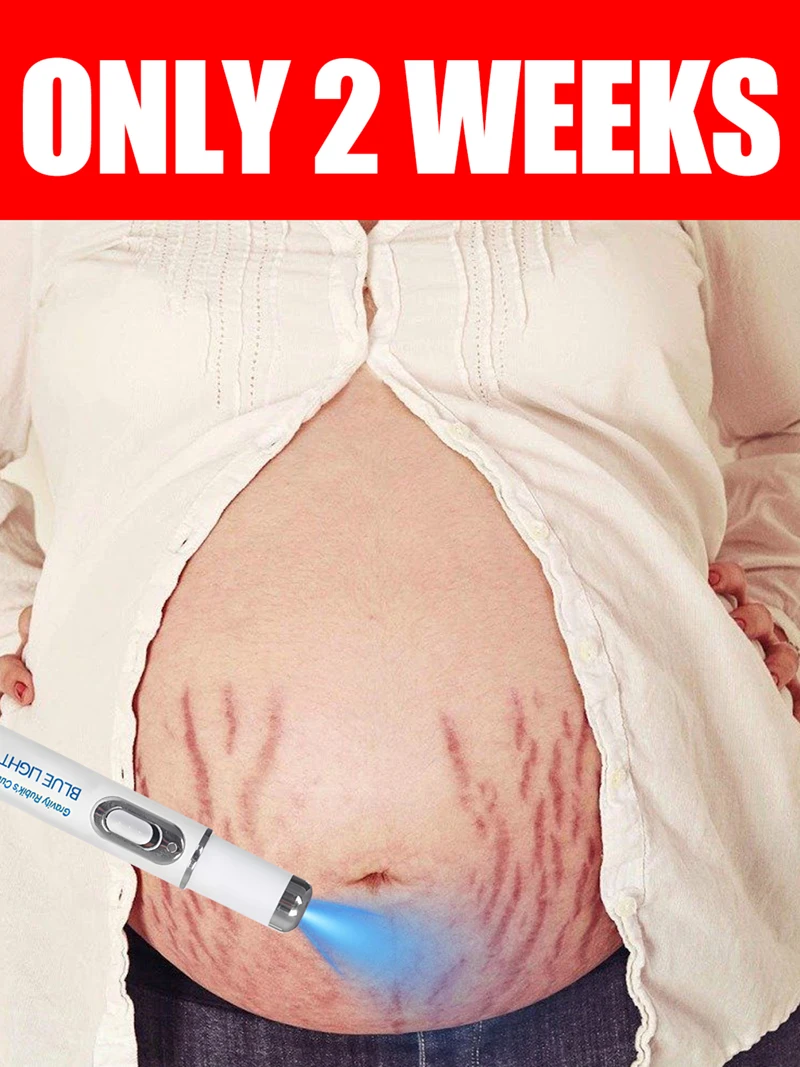 stretch marks for tunnels