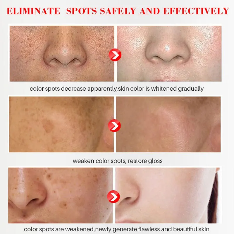 Whitening Serum Effective Remove Freckle Liquid Fade Melasma Dark Spots Fade Melanin Whiten Brighten Korea Skin Care Products