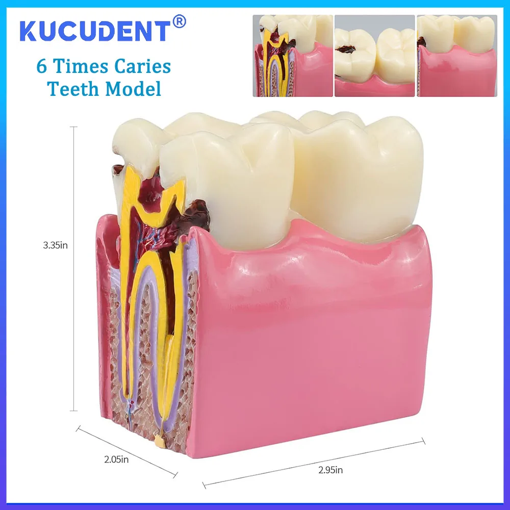 KUCUDENT Dental 6 Times Caries Teeth Model Student Studying Dentist Teaching Comparation Demonstration Training Researching