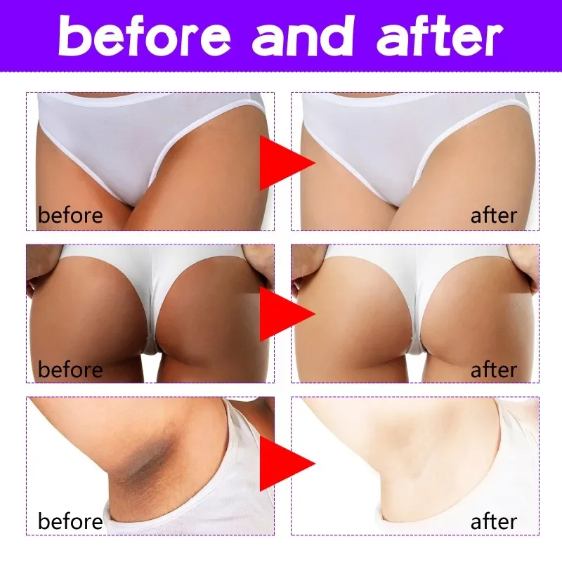 Body Whitening Cream Dark Skin Intimate Areas Brightening Cream Armpit Knee Private Parts Underarm Body Cream Lotion Skin Care