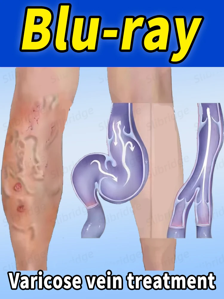 

Solve problems such as spider legs, varicose veins, phlebitis, etc. Improve blood vessels