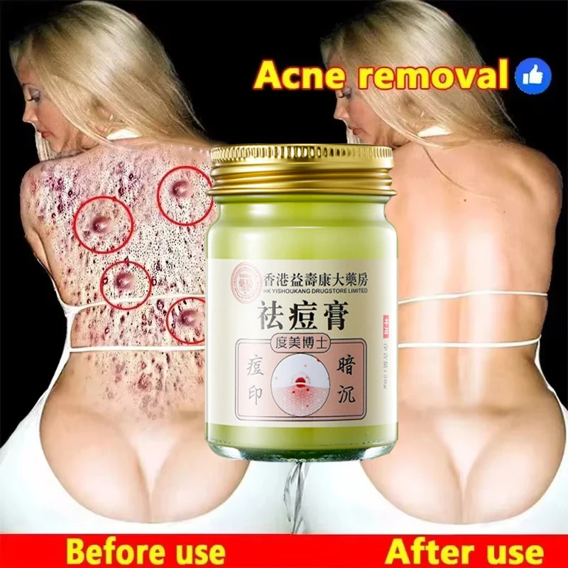 Crema para eliminar el acné corporal, tratamiento facial, trasero, marcas de acné, reparación suave, crema para la piel de pollo, blanqueamiento hidratante, cuidado de la piel