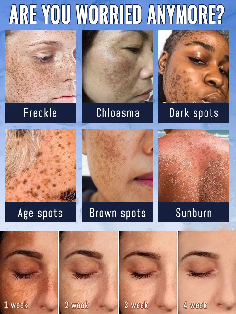 肌の色ムラを効果的に除去し、完璧な肌を取り戻します