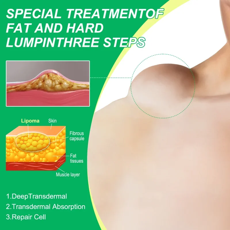 Lipoma Treatment Herbal Plaster Pain Relief Ointment Multiple Anti-Tumor Peeling Fat Mass Remover Cream Health Care Products