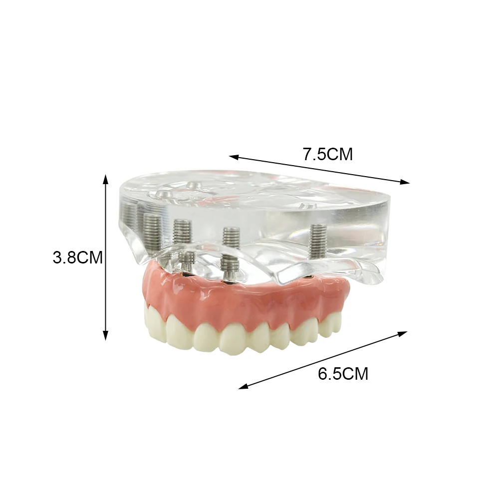 Upper Jaw Dental Implant Model With 6 Implants Maxillary Removable Covered Denture For Teaching Studying Education Demonstration