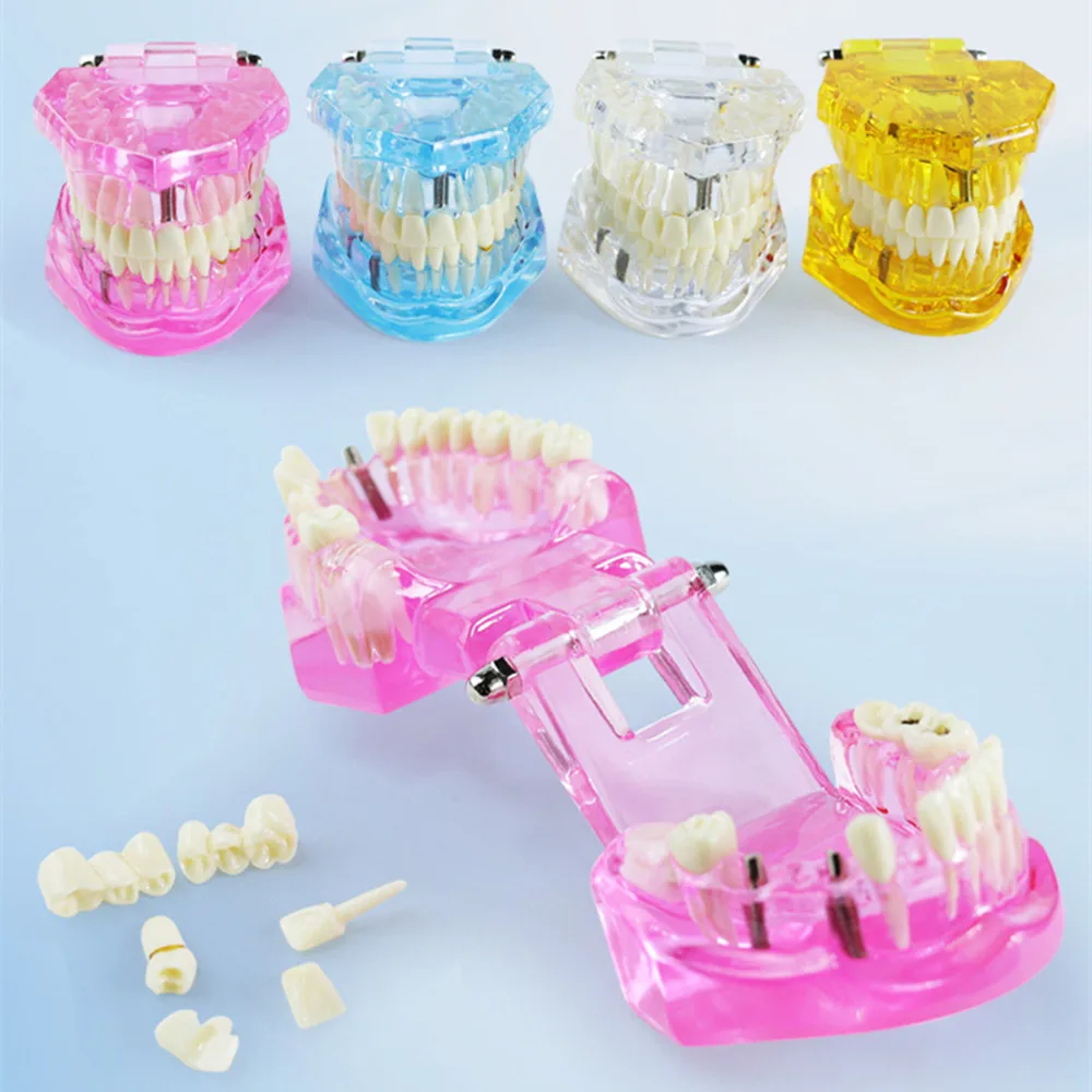 Modèle de pathologie dentaire, modèle de démonstration de maladie du canal radiculaire avec dents détachables, typodont transparent normal, outils d'entraînement et d'enseignement