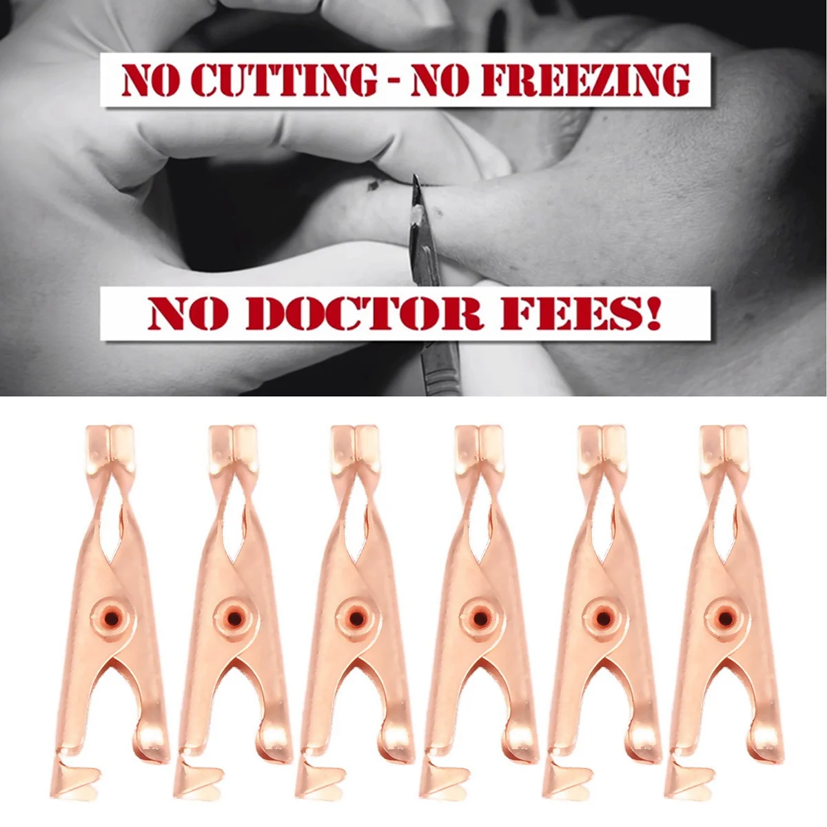 AT29-1 Box/12Pcs Copper Skin Tag Remover Clips Wart Tag Extractor Copper Tag Out Skin Tag Removal Tool