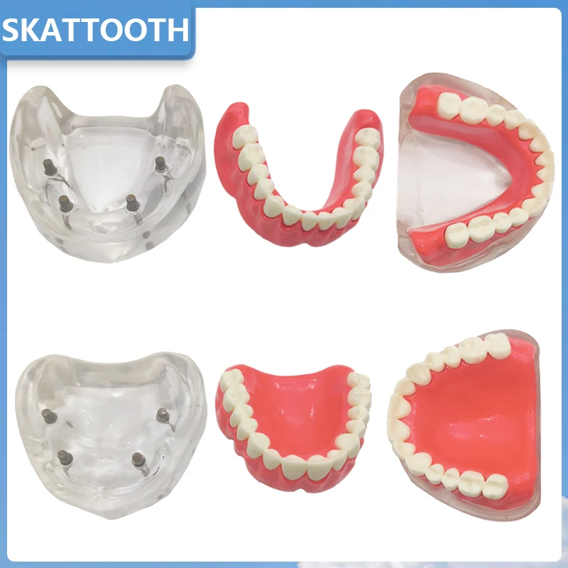 Dental Overdenture Restoration Model With 4 Implants Upper/Lower Jaw Removable Implant Model for Dentisit Teaching Research