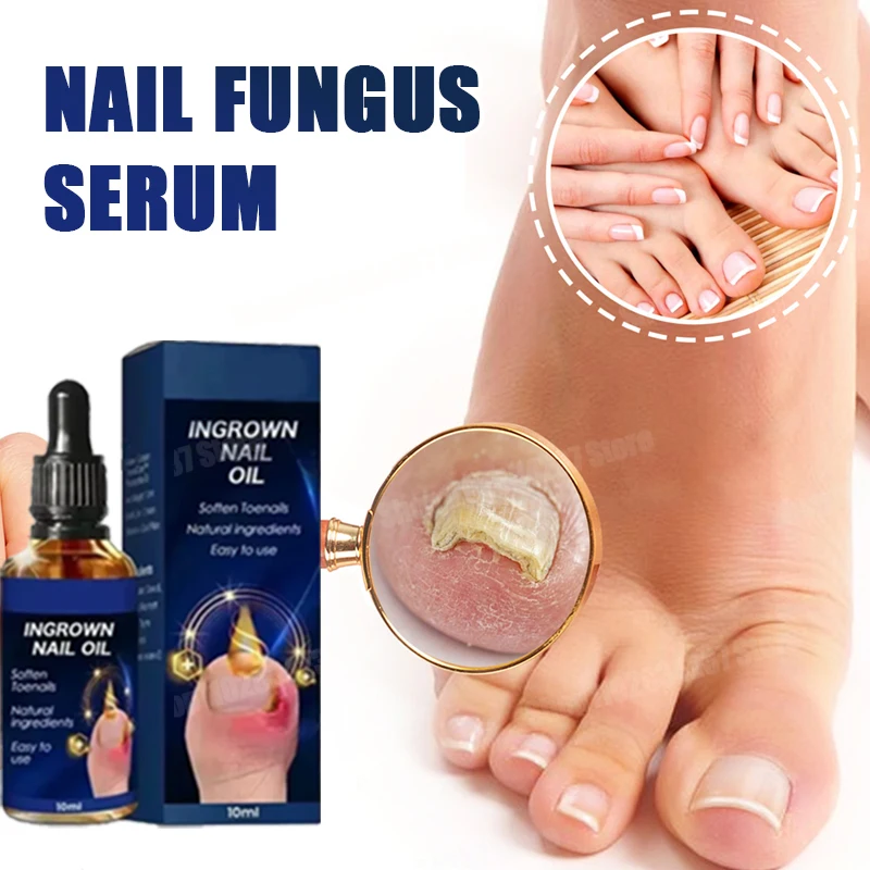 Nail Fungus Serum Foot Repair Liquid Toe Nails Fungal Removal Gel Anti Infection Paronychia Onychomycosis