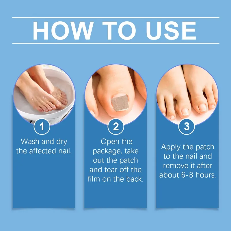 متعددة الأغراض مسمار تجديد بقع سماكة لينة بارونيشيا مكافحة العدوى مسمار رقعة إصلاح الأظافر ملصقات تصحيح العناية بالقدم