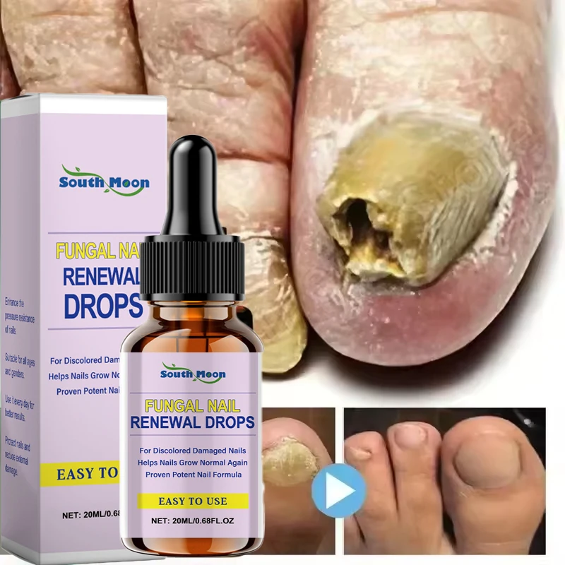Nail Fungal Repair Serum Foot Toe Nail Fungus Removal Essential Oil Anti Infection Onychomycosis Paronychia Repairing Care
